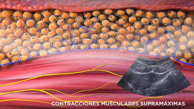 EMSCULPT® Mecanismo de acción para la tonificación muscular y